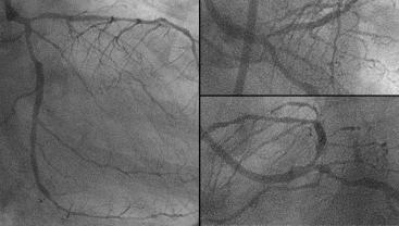 Case 2: Stenting for LAD ostial lesion accompanied by LCx ostial lesion. There was diffuse plaque around distal LMT including the orifice of LAD and LCx( fig 4).