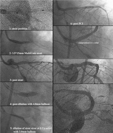 High pressure postdilation(16 atm) was done with 4.0mm balloon protecting LCx with another wire(fig 5:pic 4) and then the orifice of LCX was dilated with 3.