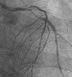 figure 6: case2-urgent angiography 2 months after the PCI and repeat PCI was immediately carried out.