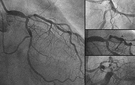 If the eccentric lesion with heavy calcification is seen at the orifice, stent is unable to be fully expanded because it is easily compressed by caicification.
