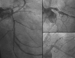 figure 10: Case 4- pre PCI Case 4: calcified CTO located in LAD ostial.