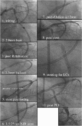 In addition to these anatomical condition, the entry of CTO existed opposite the LCx. It means that stenting without debulking causes plaque shift to LCx. In this case 3.