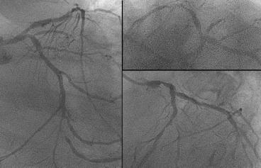 figure 12: Case 4-3months follow-up angiography Unfortunately this patient had new lesion in LMT and mild restenosis in the suboptimally dilated segment.