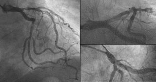 figure 15: Case 5-3 months follow-up angiography c) DCA prior to stenting As already described, the restenosis rate after DCA prior stenting is the lowest among other strategies.