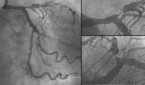 no need to precisely position the stent edge just at the orifice of LAD: it allows to prevent plaque shift and to remain various options for subsequent intervention if restenosis occurs.