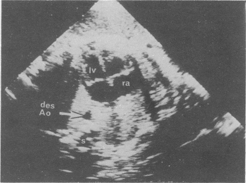 1-3 Since then fetal echocardiography has been carried out in many pregnancies that are at increased risk of congenital heart disease, and more recently the study of one section of the fetal heart