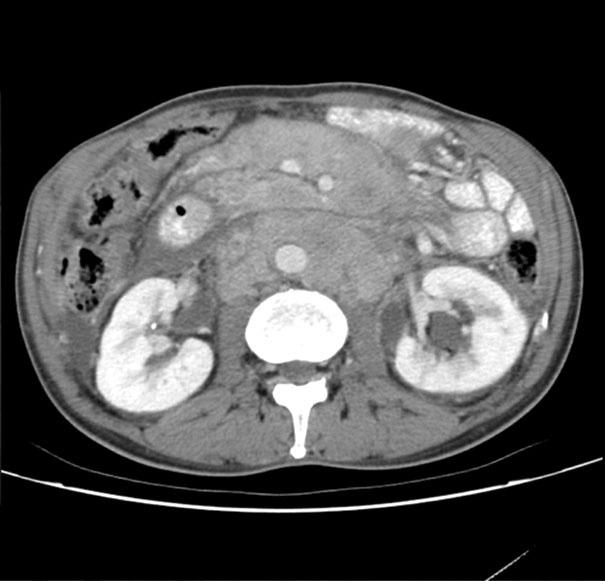 pylori infection Abdomenpelvis CT BM involvement Chest CT Tumor depth by EUS PET Stage Initial treatment 12-mo outcome 1 F 40 Weight loss Negative LN (+) No Not done Not done Not done II Chemotherapy