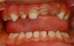untreated caries was significantly