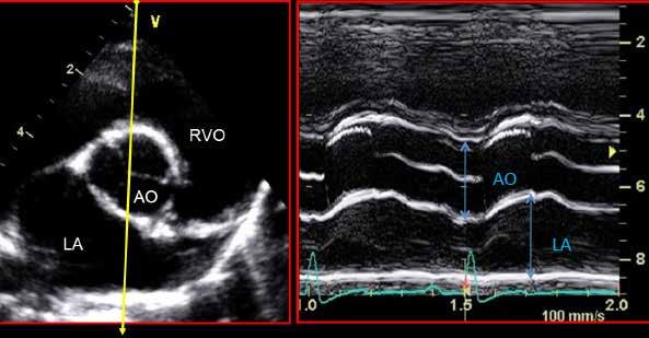 M-mode left atrium/aorta level Obtained from the right-sided short-axis or long-axis outflow tract view Evaluate the opening of the aortic valve and dimensions of the aorta Evaluate left atrial size