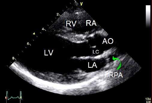Right parasternal long axis inflow/outflow Obtained from the right side Left ventricular inflow and outflow tract morphology Subjective assessment of left ventricular function Evaluate for systolic