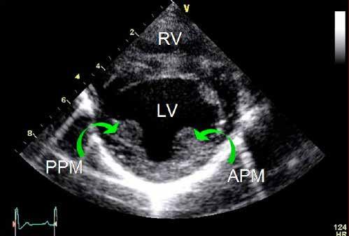 Right parasternal short axis papillary muscle level Obtained from the right side Evaluate left ventricular wall thickness Evaluate left ventricular wall motion Evaluate papillary muscle size and