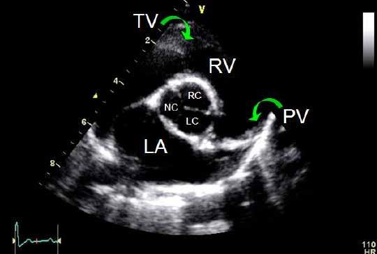Right parasternal short axis left atrium/aorta Obtained from the right side Evaluate left atrial size Evaluate aortic valve morphology and movement Evaluate tricuspid valve and right ventricular
