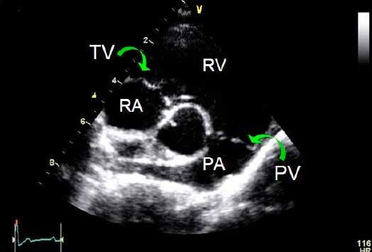 Right parasternal short axis right ventricular outflow tract Obtained from the right side Evaluate the right ventricular outflow tract, including Doppler evaluation Evaluate the right atrium and