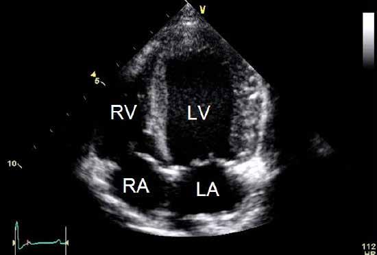 Left apical four chamber Obtained from the left side Relative comparison of the left and right heart to subjectively evaluate size and function Evaluate mitral valve morphology and motion Evaluate