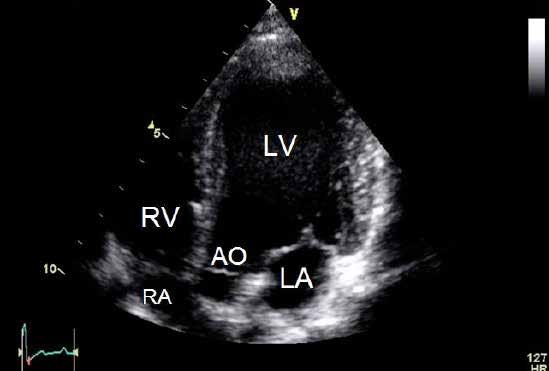 Left apical five chamber Obtained from the left side Evaluation of the left ventricular inlet and outflow Evaluate mitral valve morphology and motion Doppler evaluation for mitral valve regurgitation