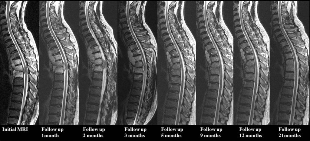 Dae Jung Kim et al patients had two involved vertebrae, one patient had three involved vertebrae, and two patients had more than four vertebrae involved.