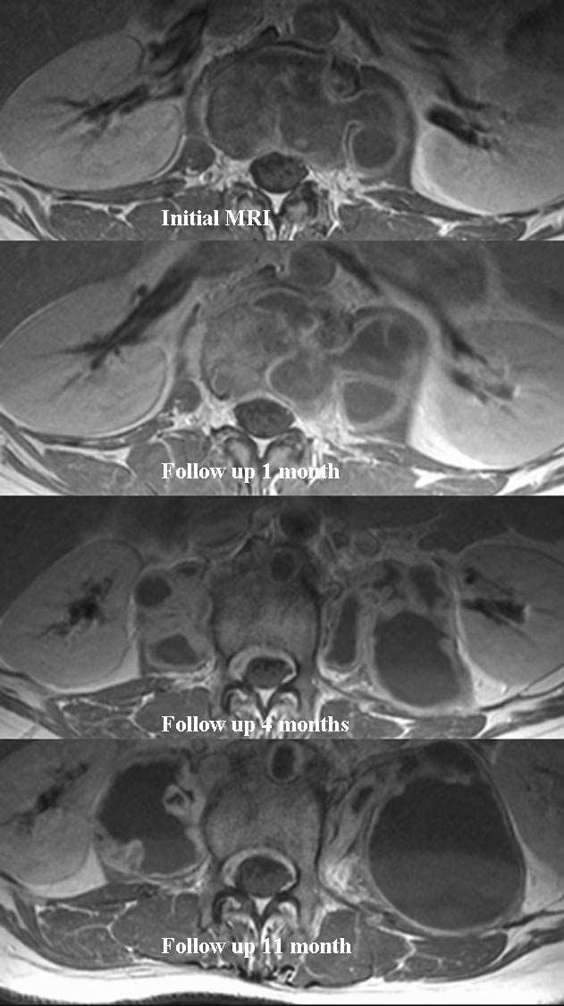 Clinical Significance of MRI Findings During Medical Treatment for Tuberculous Spondylitis patients who received complete treatment and four patients who received incomplete treatment.