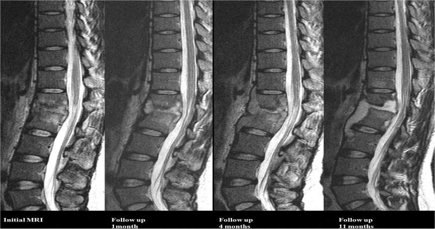 body height (4/6), and fatty changes of the spinal lesions (6/6).