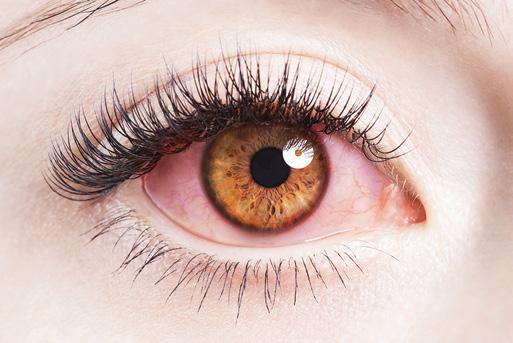 WHAT ARE THE SYMPTOMS OF A CORNEAL CONDITION?