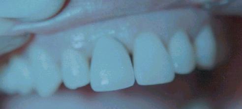 a: Pre-op (tooth-implant supported