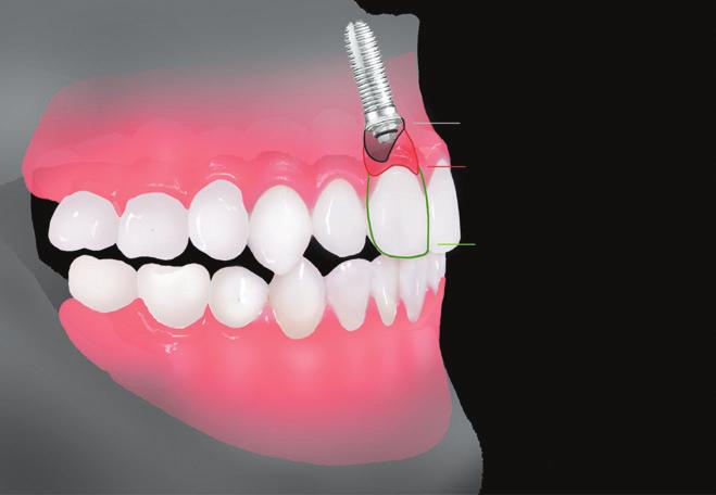 The concave surface serves as a reservoir for microorganisms, which may ultimately impact the health of the peri-implant tissues. 3.