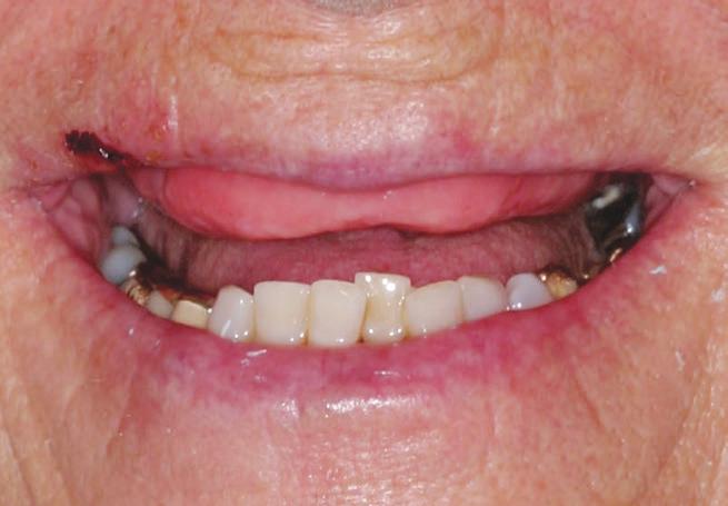 A long upper lip is a more favorable situation for the restorative dentist. Patients should be asked to smile with and without the denture in place.