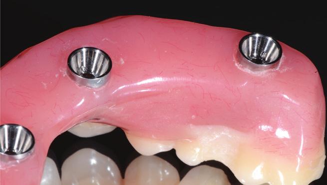 4. Emergence and Contours One of the best diagnostic tools is the patient s existing maxillary denture.