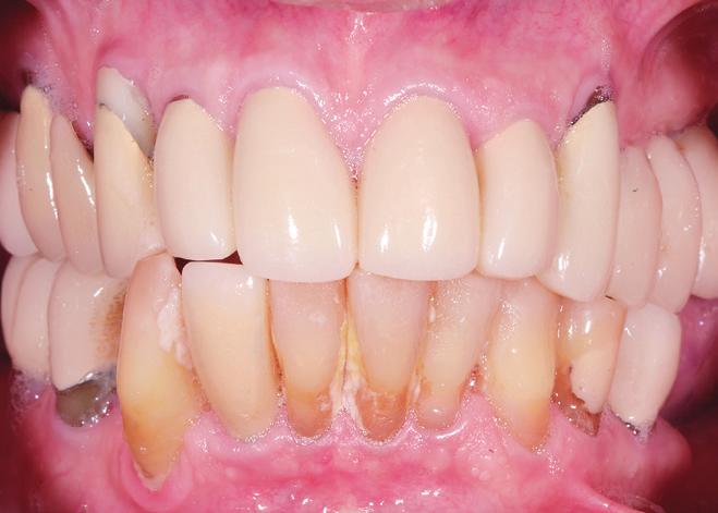 36 Figure 5. Window in duplicate of denture with correct incisal-edge position.