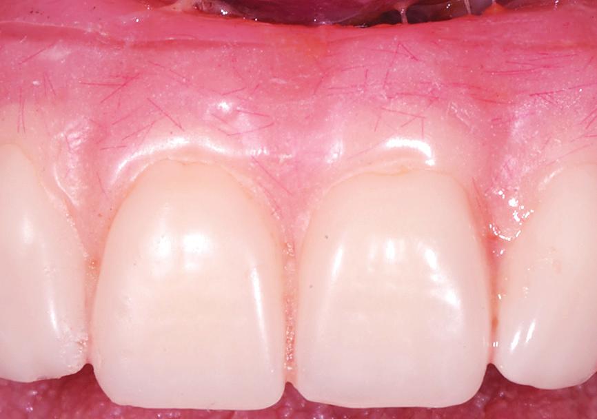 Anterior teeth are removed; posterior teeth