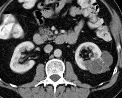 CT Renal cysts B2F BOSNIAK 2F cannot be considered benign without a period of observation (2-5 years) Introduced 2003*