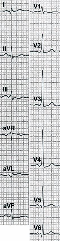 12 2 Practical Approach ECG 2.1 Preexcitation with short PQ interval (0.10 s). Obvious positive delta waves in III and avf.