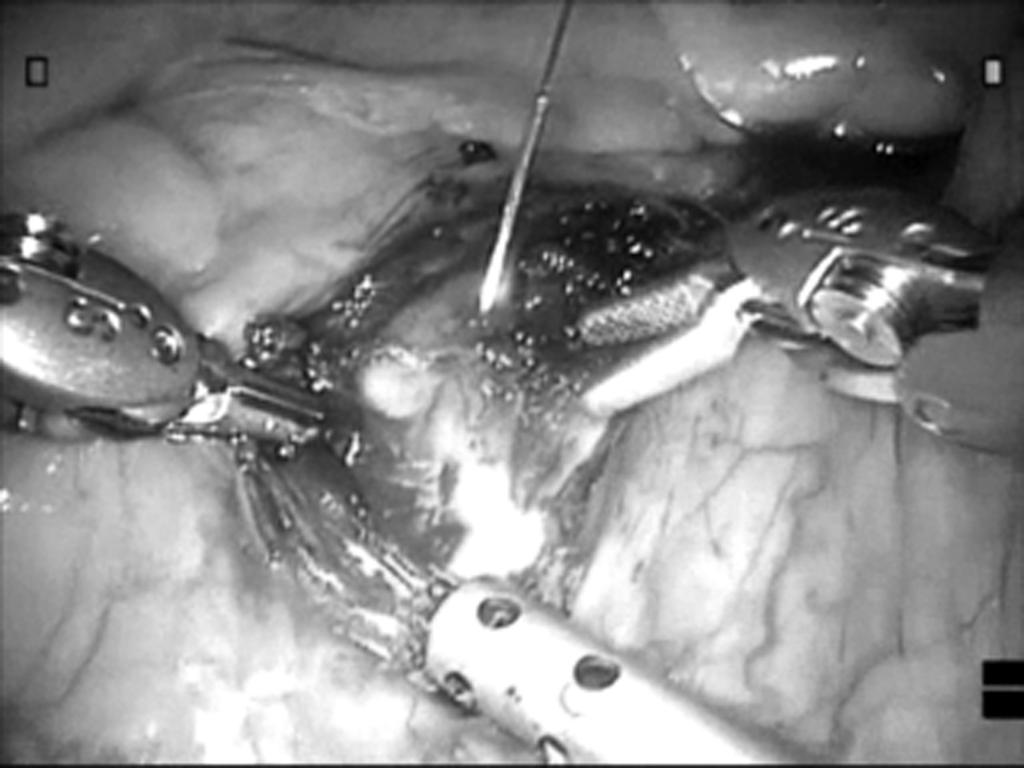 Supracervical Robotic-Assisted Laparoscopic Sacrocolpopexy for Pelvic Organ Prolapse, Benson AD et al. ligament fixation procedure.