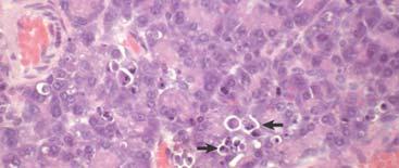 (arrows). Cytoplasmic buds are found in adjacent cells. Inflammation is absent.