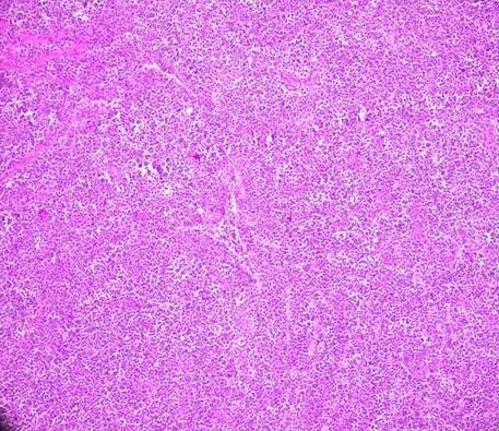 Figure - 2: Gross specimen of right ovary. Figure - 4: (10X view) Photomicrograph showing tumor tissue arranged in sheets.