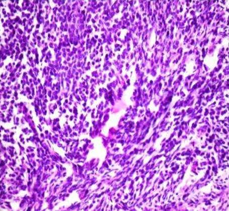 Figure - 7: Photomicrograph showing ovary with infiltration by tumor cells (Top field showing large