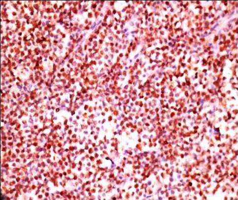 lymphoma originates from local antigen-responsive B cells.