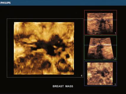 islice is especially helpful when assessing the true extent of a mass. islice allows you to select 4, 9, 16 or 25 precision tomographic slices for thorough breast assessment.