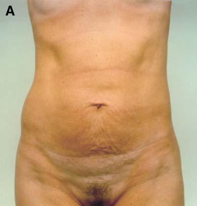 548 L.S. Toledo / Clin Plastic Surg 31 (2004) 539 553 Fig. 6. (A,B) Preoperative view of a Type IV patient, with mostly muscle-aponeurotic flaccidity and excess skin.