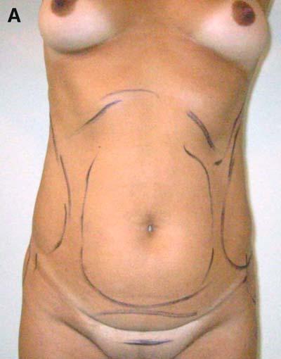 L.S. Toledo / Clin Plastic Surg 31 (2004) 539 553 549 orthostatic position. Suction drains are placed for 2 to 3 days when the author combines suction and abdominoplasty.