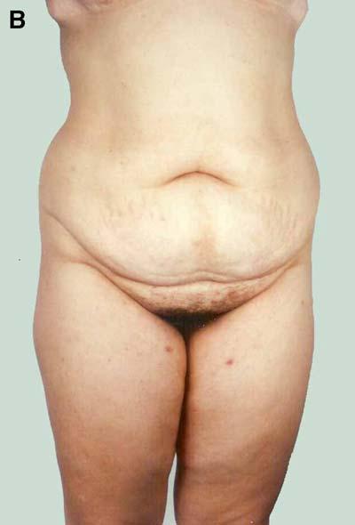 This patient, an obvious Type V, preferred to be treated by liposculpture alone, which