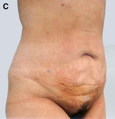She had an obvious excess of skin and fat and should have been treated by a classic