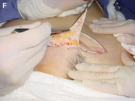 (A) In a Type III abdomen the skin excess excision is