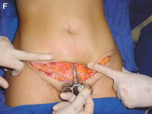 When the patient does not want any incision around the umbilicus, the surgeon can combine the suprapubic skin resection and liposuction, preserving the perforators.