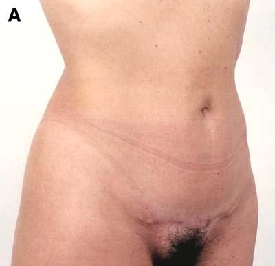 L.S. Toledo / Clin Plastic Surg 31 (2004) 539 553 547 Fig. 5. (A) A 38-year-old Type III patient with excess skin in the epigastrium and a wrinkled skin above the umbilicus. (B) Preoperative view.