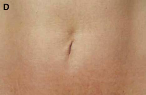 Despite reduced incidence of complications with these techniques, there is one rule to which the surgeon must adhere: the classification of the abdomen based on the degree of skin and muscle laxity