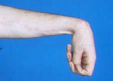 Wrist Deformity: Joint