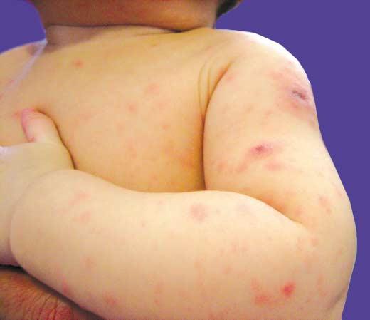 He presented with cough since November 2006. He developed a few non-pruritic papular rash on scalp, back and legs in December 2006. The skin rash remained static before admission.