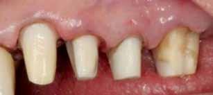 Before the periodontist even treats the patient, the restorative dentist must perform caries removal and place core buildups and provisional crowns.