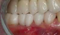Removing the provisionals gives the periodontist vertical access to all interproximal Fig. 9. The provisional restoration is relined 1 mm coronal to the tissue margin.