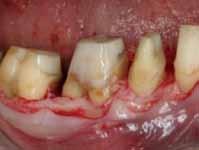 The periodontist started by removing all CEJs and irregularities on the root surfaces.